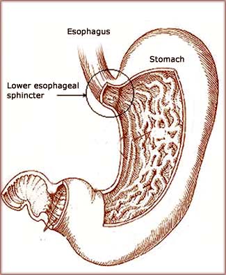 GERD diet: Drawing of stomach and lower esophagael sphincter